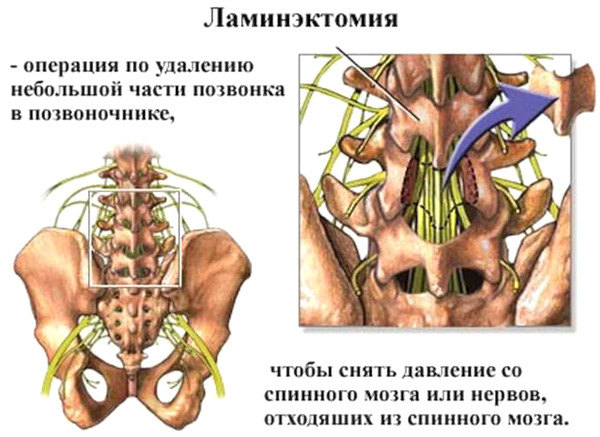 Фораминальный стеноз поясничного отдела позвоночника