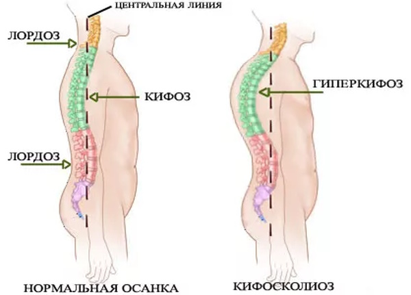 Гиперкифоз грудного отдела позвоночника. Что это такое, 1-2-3 степени, лечение