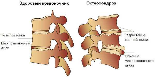 Гипертрофия желтых связок пояснично-крестцового отдела позвоночника