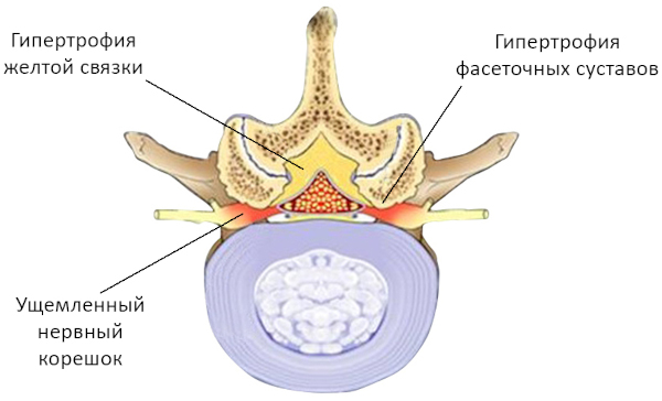 Гипертрофия желтых связок пояснично-крестцового отдела позвоночника