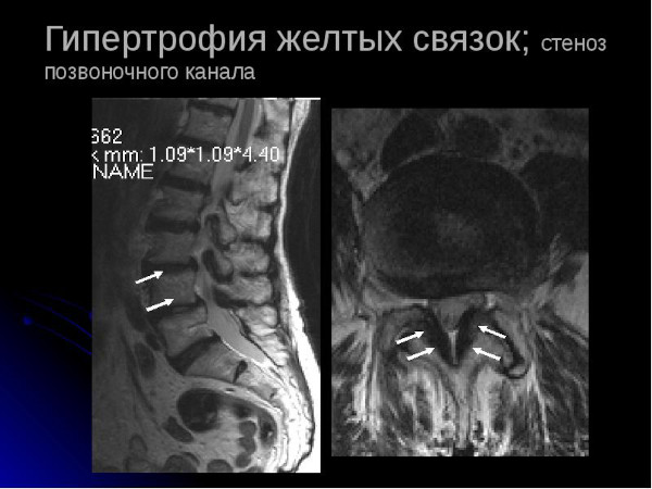 Гипертрофия желтых связок пояснично-крестцового отдела позвоночника