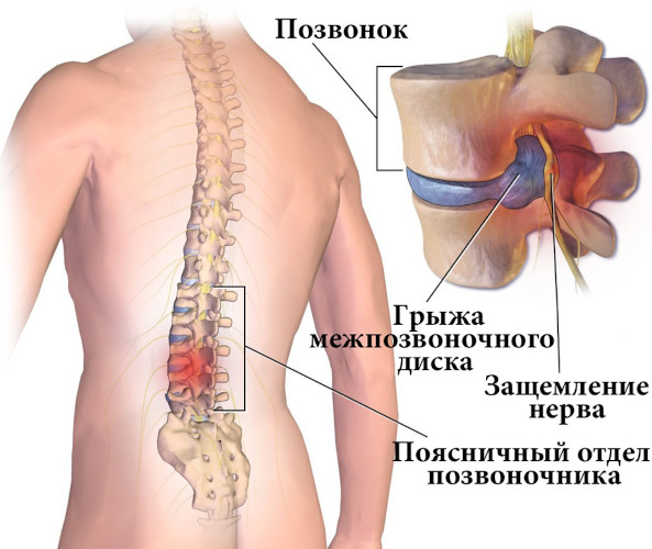 Ходьба при грыже поясничного отдела позвоночника. Полезно ли ходить