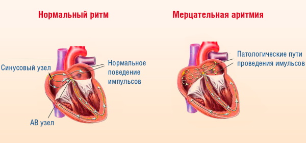 Ибупрофен при цистите у женщин. Как принимать, поможет или нет