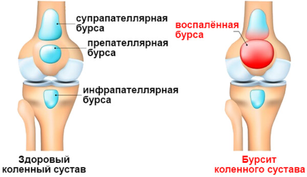 Компресс для суставов при воспалении коленного сустава, болях, артрозе, бурсите, ушибе