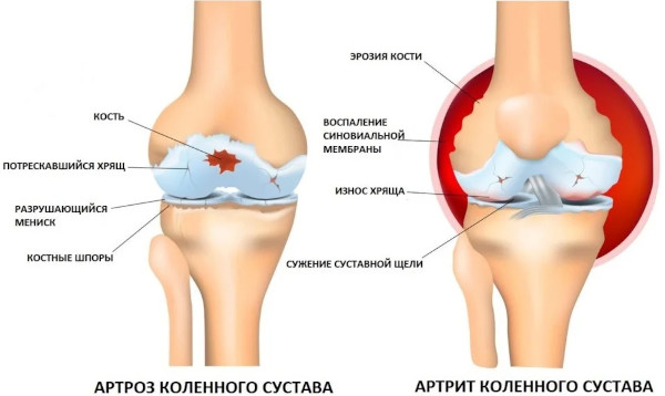 Компресс для суставов при воспалении коленного сустава, болях, артрозе, бурсите, ушибе