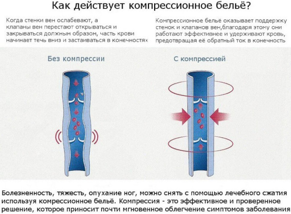 Компрессионные колготки 1-2 класс компрессии для женщин. Как выбрать