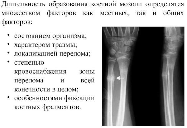 Костная мозоль после перелома. Фото на рентгене, как убрать без операции