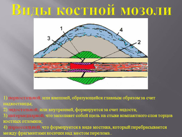 Костная мозоль после перелома. Фото на рентгене, как убрать без операции