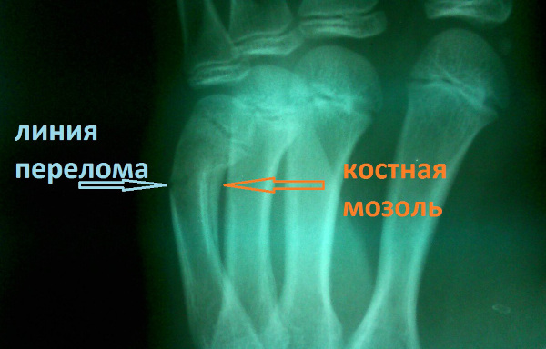 Костная мозоль после перелома. Фото на рентгене, как убрать без операции