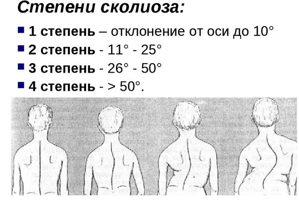 Левосторонний сколиоз поясничного отдела позвоночника 1-2 степени