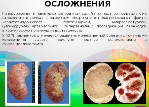 Мази от подагры на ногах. Самые эффективные средства. Список