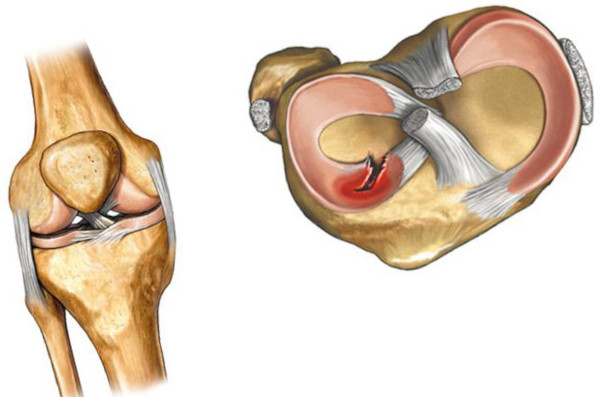 Менисцит коленного сустава. Что это, лечение