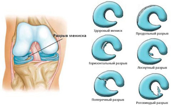 Менисцит коленного сустава. Что это, лечение