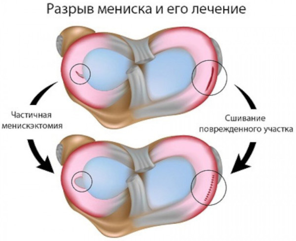 Менисцит коленного сустава. Что это, лечение