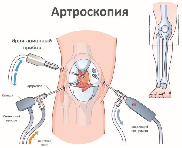 Менисцит коленного сустава. Что это, лечение