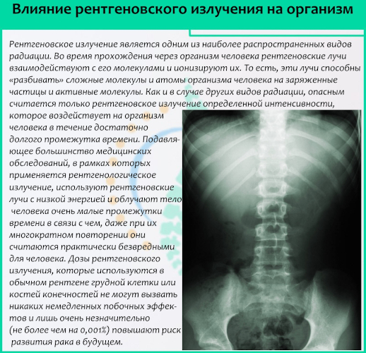 МРТ или рентген позвоночника: что лучше?