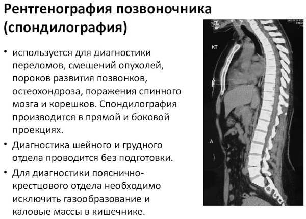 МРТ или рентген позвоночника: что лучше?