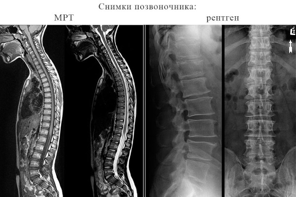 МРТ или рентген позвоночника: что лучше?