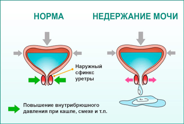 Нарушение функции тазовых органов у взрослых