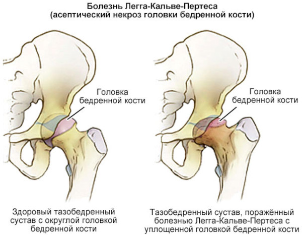 Опасность остеохондроза шейного, грудного, поясничного отдела