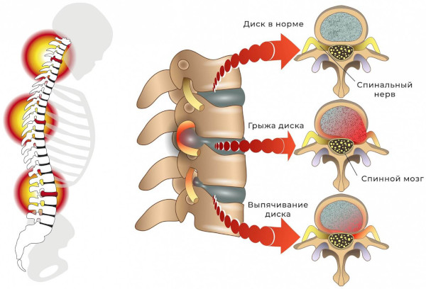 Опасность остеохондроза шейного, грудного, поясничного отдела