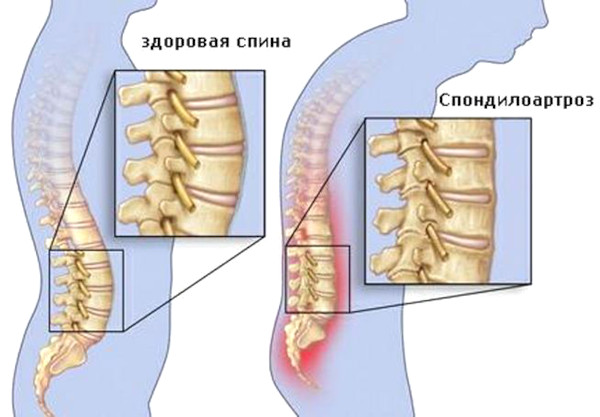 Опасность остеохондроза шейного, грудного, поясничного отдела