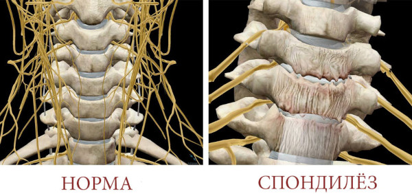 Опасность остеохондроза шейного, грудного, поясничного отдела