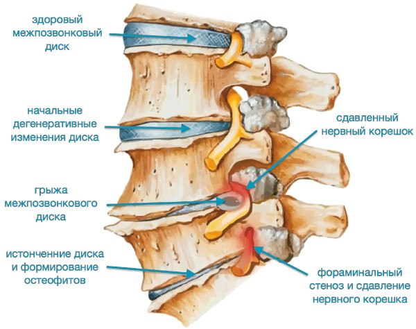 Опасность остеохондроза шейного, грудного, поясничного отдела