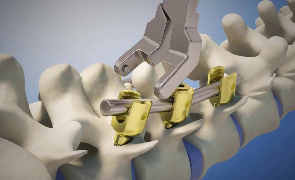 Операции на позвоночник с металлоконструкцией при грыже, сколиозе