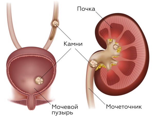 Остаточная моча у женщин, хроническая задержка. Как сходить в туалет по-маленькому