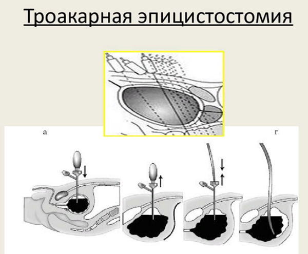 Остаточная моча у женщин, хроническая задержка. Как сходить в туалет по-маленькому