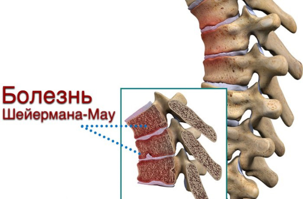 Остеохондропатия позвоночника. Что это у детей, подростка, лечение