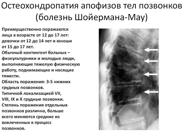 Остеохондропатия позвоночника. Что это у детей, подростка, лечение