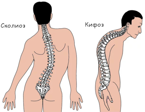 Остеохондропатия позвоночника. Что это у детей, подростка, лечение