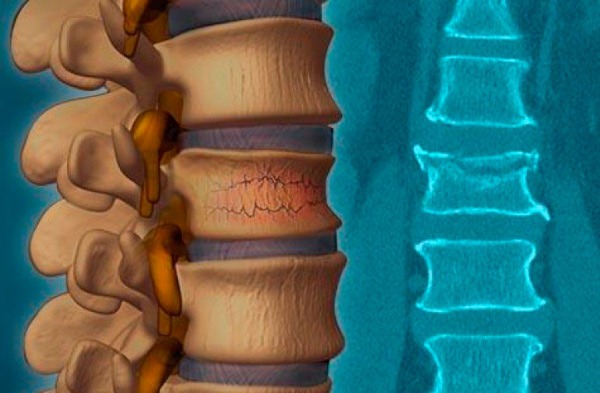 Остеохондропатия позвоночника. Что это у детей, подростка, лечение