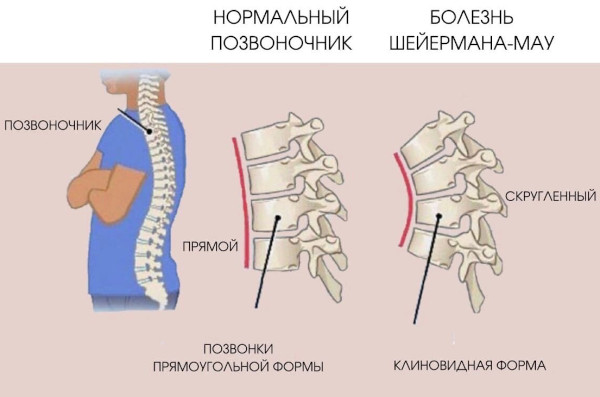 Остеохондропатия позвоночника. Что это у детей, подростка, лечение