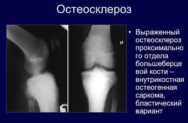 Остеосклероз. Что это такое простыми словами, лечение