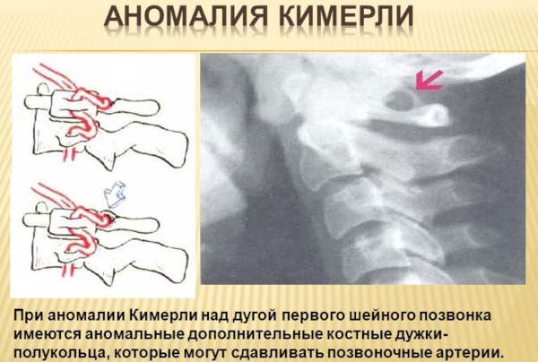 Остистые отростки позвоночника на схеме. Что это, фото, где находятся