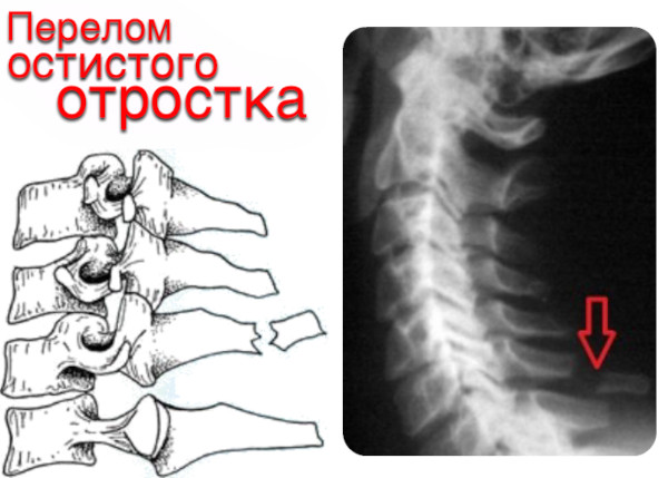 Остистые отростки позвоночника на схеме. Что это, фото, где находятся