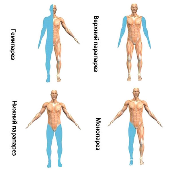Парапарез нижних конечностей спастический. Что это такое, лечение
