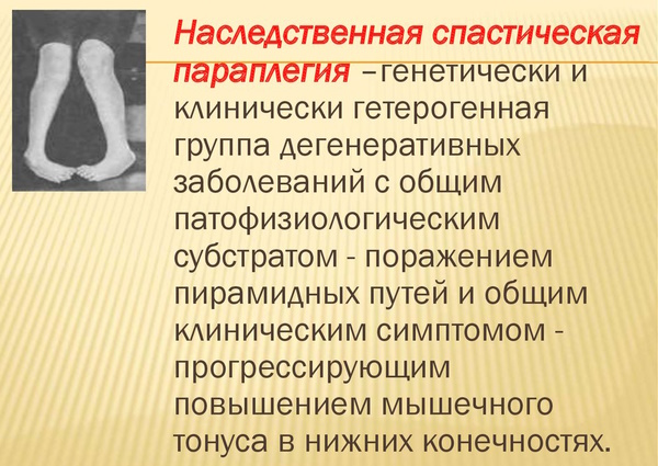 Парапарез нижних конечностей спастический. Что это такое, лечение