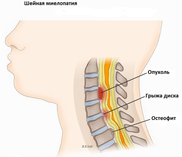 Парапарез нижних конечностей спастический. Что это такое, лечение