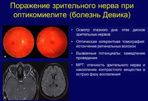 Парапарез нижних конечностей спастический. Что это такое, лечение