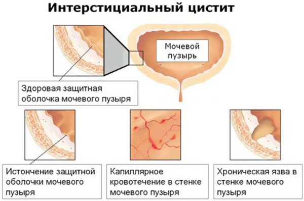 Почему больно писать в конце мочеиспускания женщине. Причины