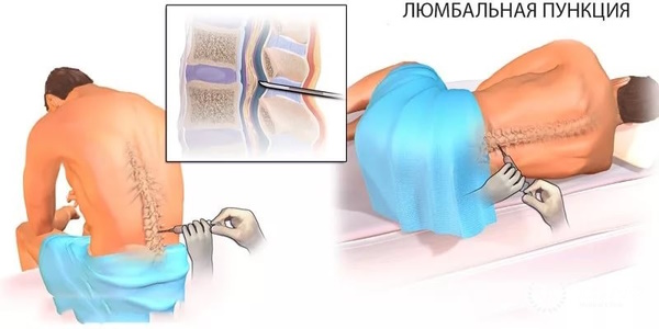 Почему нельзя терпеть головную боль, можно ли при беременности, мигрени