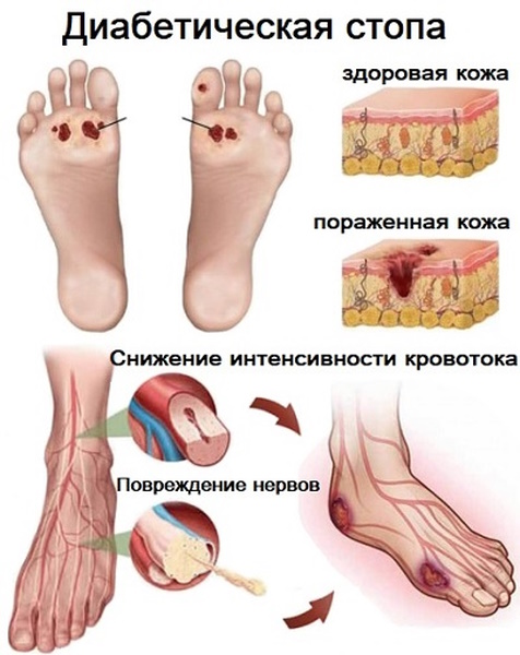 Почему отказывают ноги, отнимается левая, правая нога у пожилого человека, причины