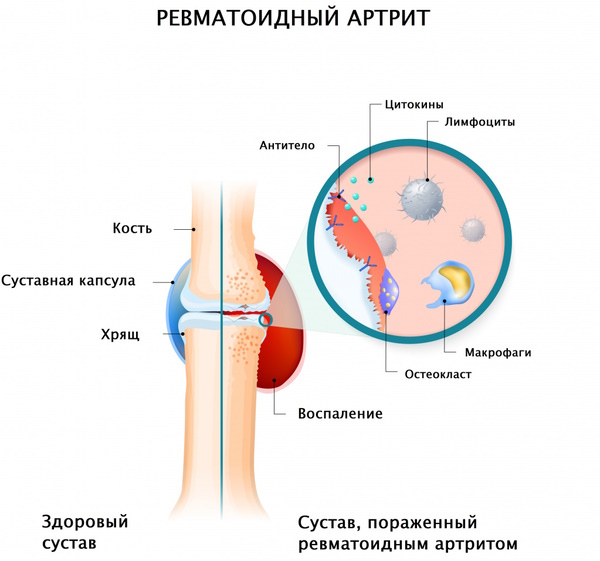 Почему отказывают ноги, отнимается левая, правая нога у пожилого человека, причины