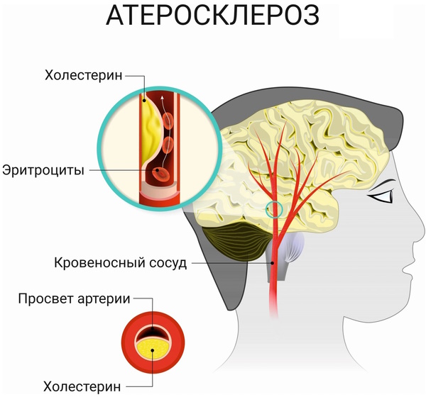 Почему отказывают ноги, отнимается левая, правая нога у пожилого человека, причины