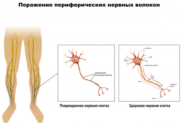 Почему отказывают ноги, отнимается левая, правая нога у пожилого человека, причины