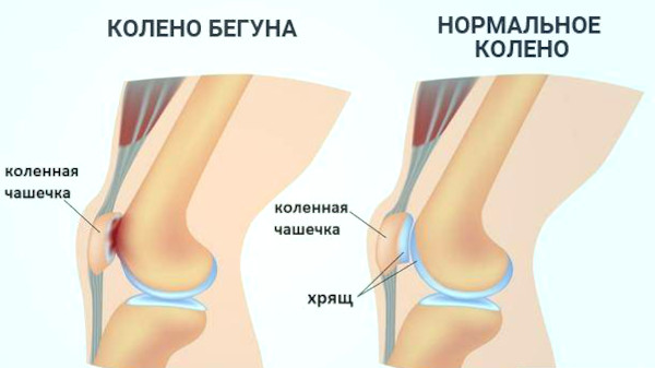 Почему щелкают суставы по всему телу, что делать